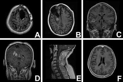 Molecular Pathological Markers Correlated With the Recurrence Patterns of Glioma